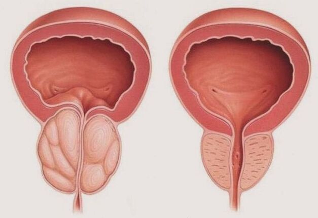 zdravá a zapálená prostata s prostatitídou