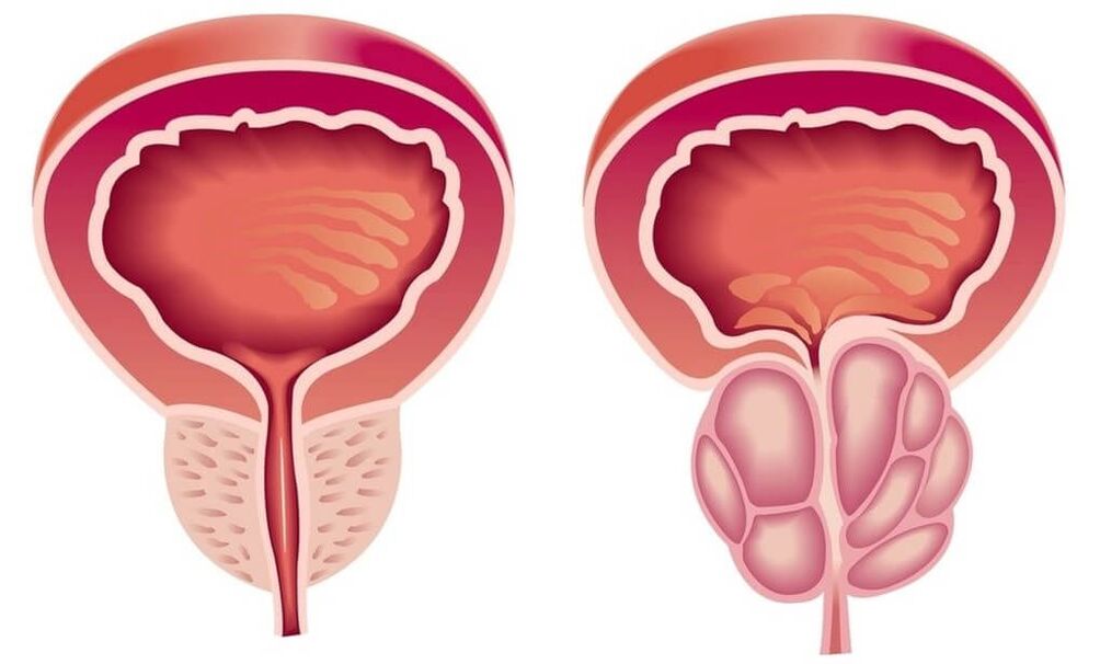 zdravá a chorá prostata